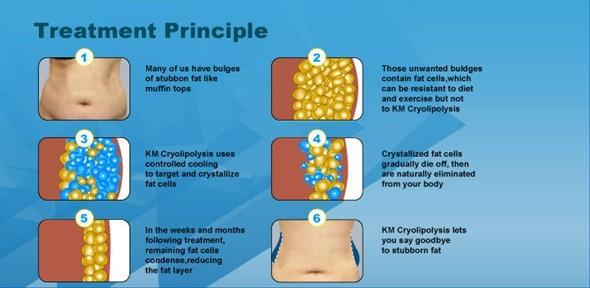 Cryotherapy fat freezing Non invasive liposuction zeltiq coolsculpting machine