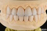 0.3-0.5mm Thick Feldspathic Porcelain Veneer High Fracture Resistance Upgrade