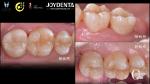 Long Lasting Natural Looking dental ceramic inlay Precise Fit High Compatibility