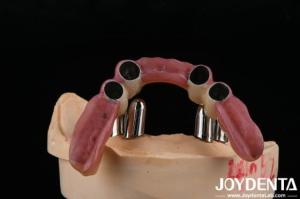 Wholesale Dental Precision Attachments Supports Partial Dentures Accurate Restorations from china suppliers