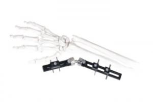 China Straight Pin Type Wrist Medical External Fixator minimal interference with soft-tissue on sale