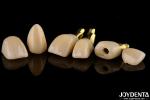 Precision Dental Implant Crown and Bridge Perfect Solution for Aesthetically