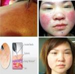 Vascular Lesion Laser Removal