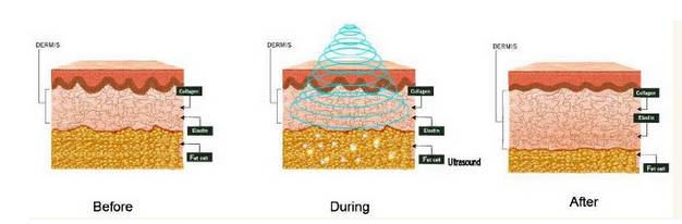 New designed RF+ Vacuum+Ultrasonic Cavitation Body Slimming Skin Lifting Machine