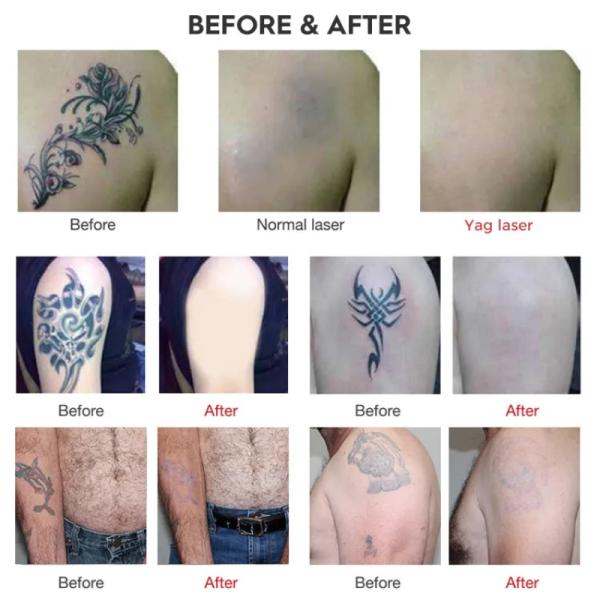 Portable ND YAG Laser Pigment And Freckle Removal Device