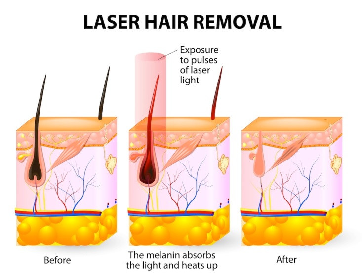 Portable 2 In 1 Diode Laser 808 Ice Cooling Hair Removal Diode Laser Machines