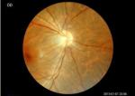 Medical Ophthalmology Portable Fundus Camera Equipment
