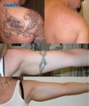 532nm 755nm 1064nm Q Switched Nd YAG Laser Machine / Tattoo Removal Beauty