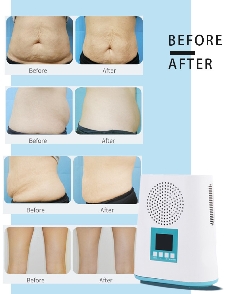 2020 hot selling portable mini cryo fat freezing/cryo slimming machine/fat eduction