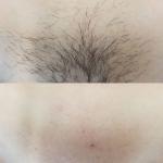 Triple wavelength diode laser machine fro hair removal