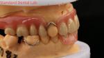 Heat Cured Ivoclar Partial Acrylic Denture Dental Lab High Accuracy with 3D