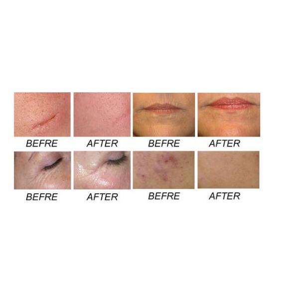 White Fractional Co2 Laser Machine