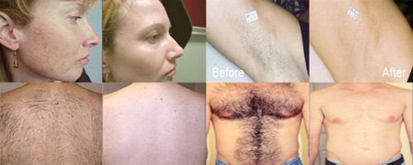 SHR IPL hair removal machine pain free equipment for beauty salon