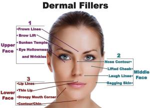 Wholesale Derm Deep Hyaluronic Acid Fillers Nasolabial Folds / Hyaluronic Acid Gel Injection With Li from china suppliers