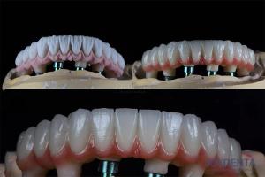 Wholesale 10mm Multiple Teeth Two Stage Dental Implant Kit For Endosseous Prosthetic Crown from china suppliers