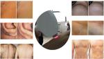CE / FDA approved powerful 808 diode laser hair removal machine