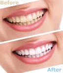 Professional LED light teeth whitening machine with mouth gag for sale