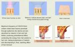 808nm Diode Laser Hair Removal System, Portable Machine,Professional Hair