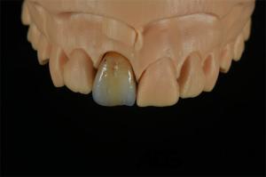 Wholesale Dental Multi Layered Zirconia Crown Manufactured By China ADS Dental Lab from china suppliers