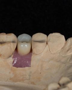 Wholesale Screw Cement Retained Implant For Long-Lasting Dental Implants With 5-Year Guarantee from china suppliers