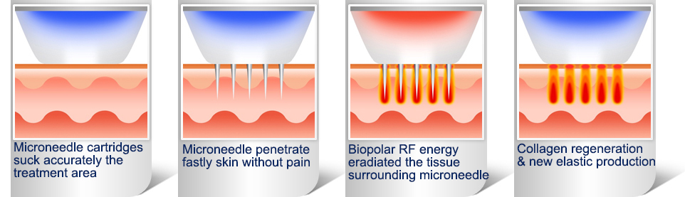 Skin Care Fractional Rf Microneedle Machine Body Radiofrequency Microneedle Beauty Equipment