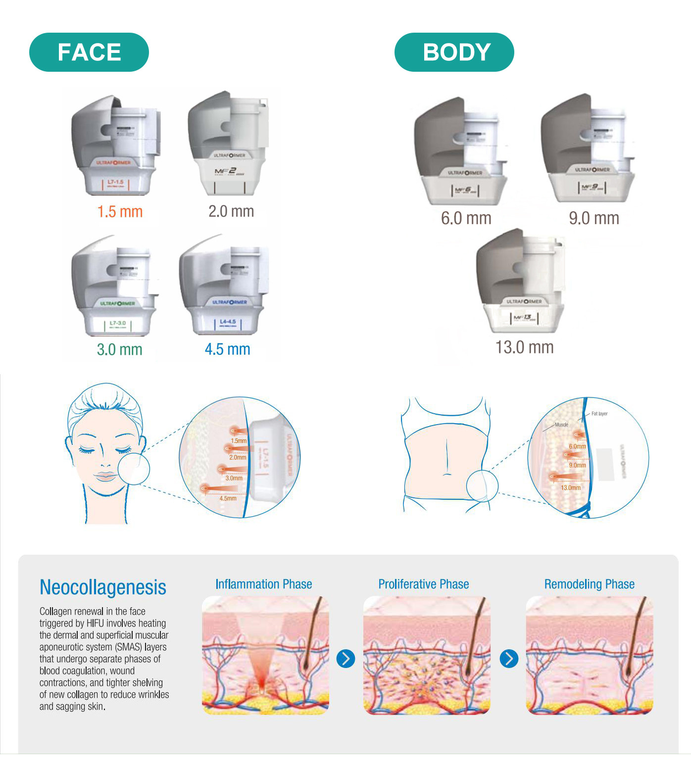 High-intensity Focused Ultrasound with Spot Size of 1-10mm Energy Level of 0.1-3J