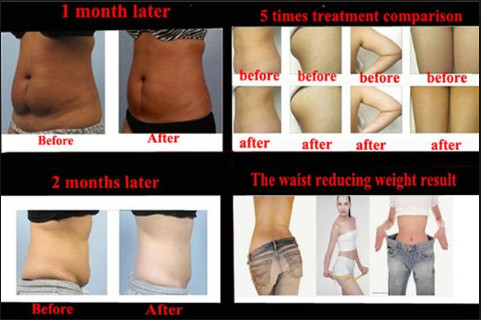 Cryolipolysis Fat Freezing Body Slimming Machine No Surgery For Body Slimming