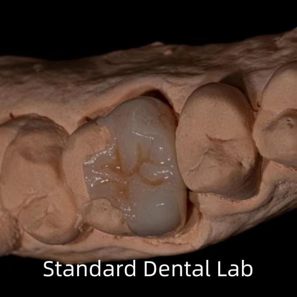 Translucency Emax Zirconia Dental Inlay Onlay Crown For Restore Natural Cavity