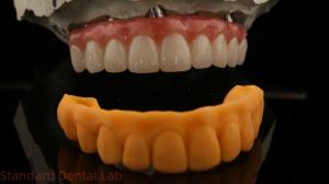 Wholesale 5 Year Guarantee Dental Implant Crown PMMA Bridge Over Multi Unit Abutments Customized Vita Shade from china suppliers