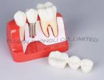 Dental Implant 3 Unit Bridge 3 Crowns Set of 6 Parts Model 4 Times Life-Size