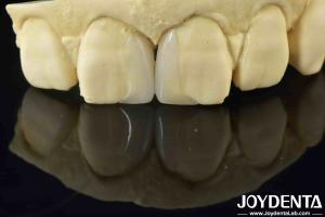 Wholesale Customizable Smooth Micro Thin Veneers Long Lasting Natural Looking Veneers from china suppliers