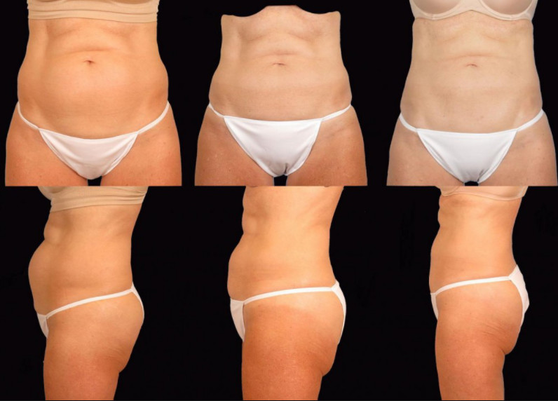 Multifunction Body Sculpture 10.4" Cryolipolysis Equipment