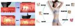 Powerful 808nm Wavelength Permanent Diode Laser Hair Removal Syetem