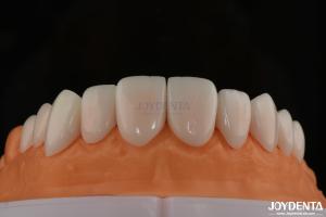 Wholesale A1-A4 Ips Emax Press Porcelain Dental Veneers Stain Resistant Customizable Shape from china suppliers