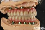 Hybrid Technology Titanium Malong Dental Bridge Adjustable For Aesthetic Results