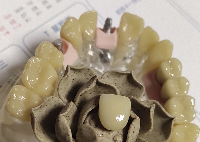 CAD Technique ISO13485 Interim Crown