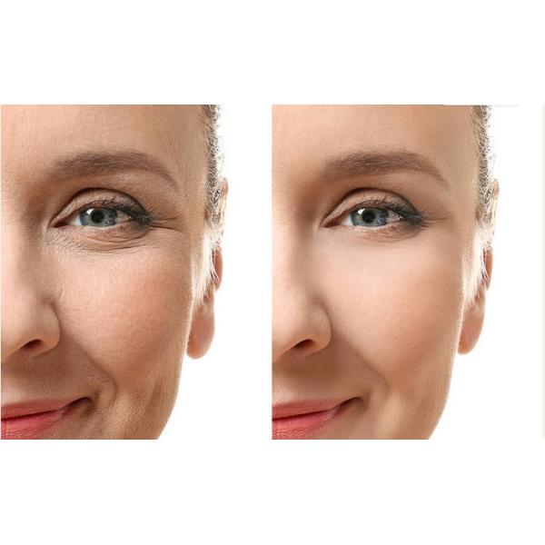 Cross Linked Fine Injectable Dermal Filler 1ml 2ml 5ml