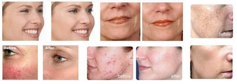 PDT Lamp LED Phototherapy Machine Skin Tightening LED PDT Machine