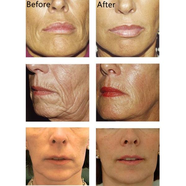 5ml Poly L Lactic Acid Filler Injectable Dermal Filler 3D PLLA