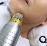 Scar Reduction Microneedling Fractional RF for Acne Scars Skin Resurfacing