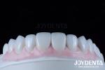 Customized Digital Diagnostic Wax Ups for Natural Tooth Anatomy Replication