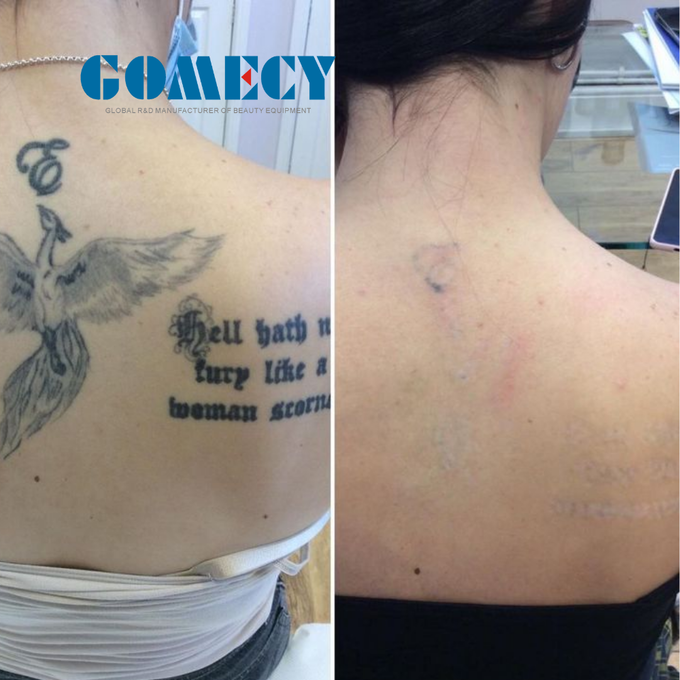 LCD Touch Screen Nd Yag Laser Tattoo Removal Machine 1064 Nm 532nm for Pigmentation Removal