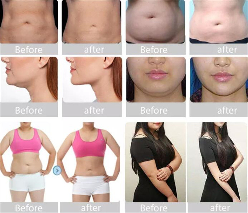 Portable 650nm Cryolipolysis Body Slimming Machine Fat Freezing 6 In1