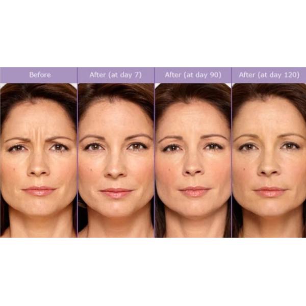 Botulinum Toxin Injection Anti Wrinkle Removal 100 Units