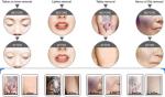 532nm 755nm 1064nm Vertical Q Switch Picosecond Laser for Acne Removal