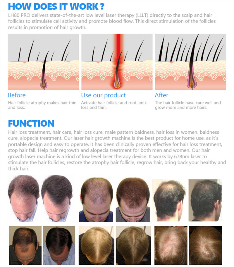 Zohonice Laser Helmet Hair Growth Hair Care Therapy Massage