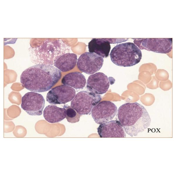 Leukocyte Peroxidase (POX) Stain (Myeloperoxidase)