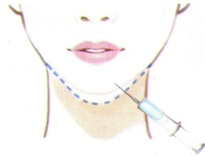 Female Care Hyaluronic Acid Facial Filler For Chin Augmentation Long Lasting