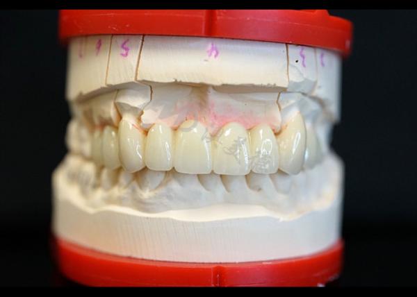 Strength Natural Esthetics Solid Zirconia Crown Perfect Fit for Single or