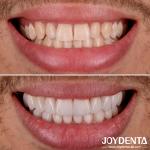 Perfect Fit Porcelain Teeth Veneers Natural Transparency Dental Laminate Veneers
